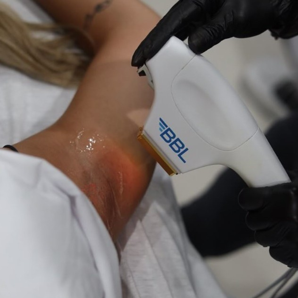 IPL hair removal sessions for 1 person - L'EXPÉRIENCE Beauté Urbaine